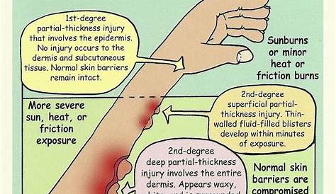 Burns Degree. Thermal Wound First Aid, Skin Scalds and Blisters
