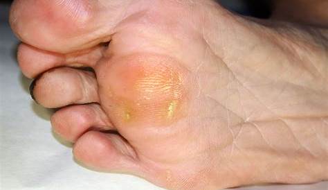 How To Easily Get Rid Of Callus Foot Pain