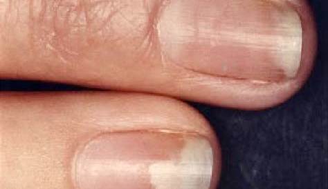 Can Acrylic Nails Cause Onycholysis Symptoms s Pictures Treatment