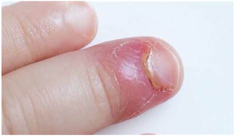 Can Acrylic Nails Cause Paronychia Acute And Chronic s Prevention & Treatment