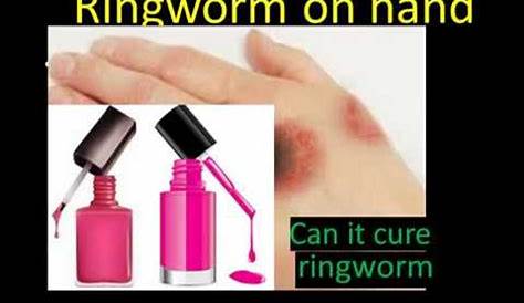Can Nail Polish Get Rid Of Ringworm