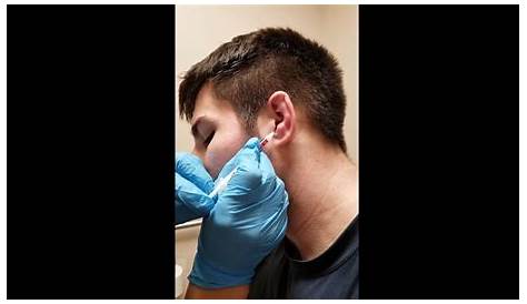 New York Cauliflower Ear Treatment, Causes, Symptoms