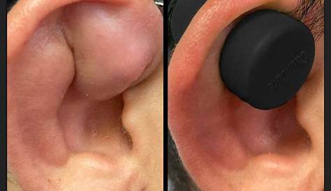 Study Medical Photos: External Ear Injuries - Brief Description With