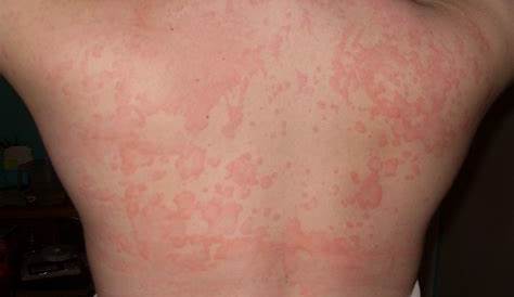 Cedar Tree Allergy Rash Symptoms