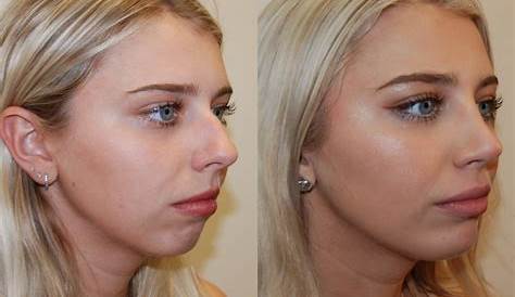 Before & After Photos | Plastic Surgery | UT Southwestern Medical Center