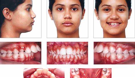 aryabrahmanta: EVALUATION OF CLASS II DIV 1 MALOCCLUSION USING ICON AND