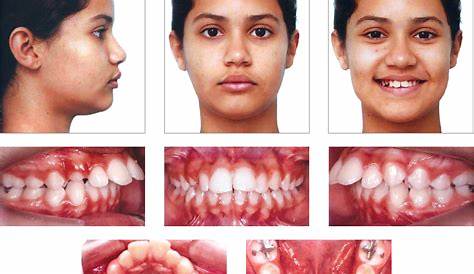 Angle’s class ii malocclusion