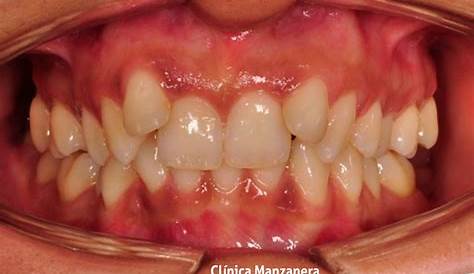 Clase II división segunda tratado con Ortodoncia Invisible - Clínica