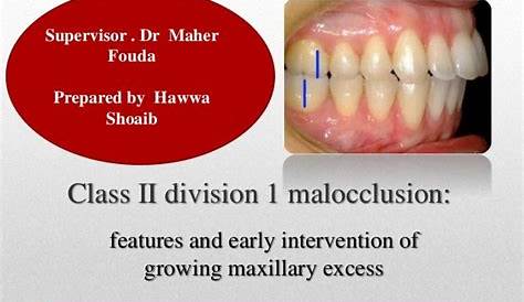 Class II division 1 malocclusion | PPT