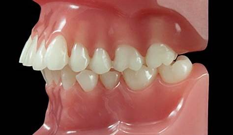 5 Class II Division 2 Malocclusion | Pocket Dentistry