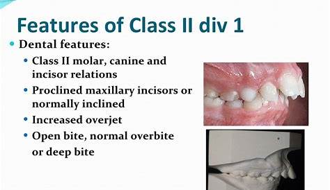 'class Ii Malocclusion' On Slideshare E75