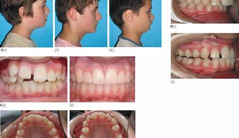 Class II division 1 - Dr Sylvain Chamberland Orthodontiste
