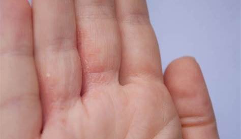 Granitos en las manos: causas, diagnóstico y tratamiento | Muy Fitness