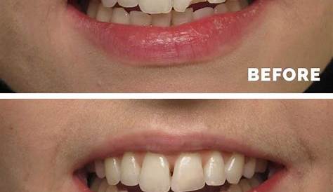 Composite Filling Anterior Teeth s Patient 5