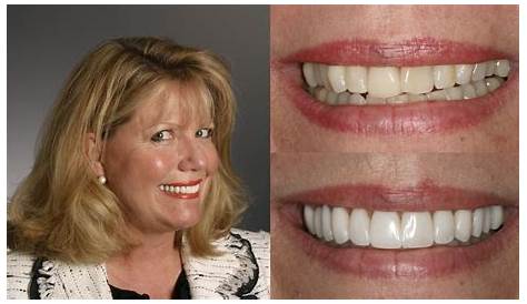 Composite Veneers On Crooked Teeth Porcelain Sydney Best Dental