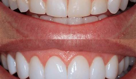 Composite Veneers Vs Porcelain Dental Abroad Cost £310, Affordable Full Set Of