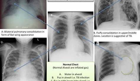 Condensation Pulmonaire Syndrome De
