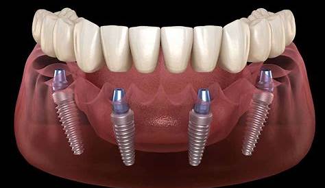 All-on-4 Dental Implants in Costa Rica