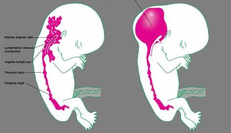 Cystic Hygroma In Fetus Pictures & Adults, Causes, Prognosis And