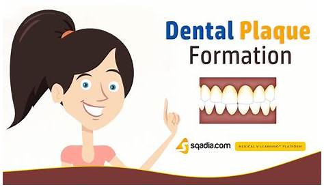 Dental Plaque Formation Animation Étape De De Carie Dentaire. Dent Saine, Formant