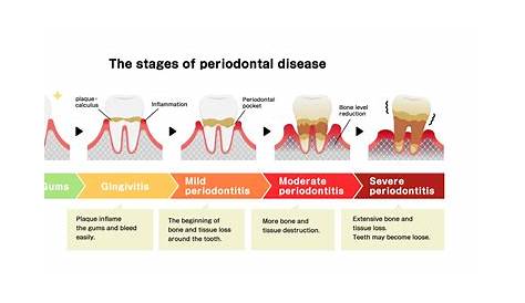 Formation of plaque on teeth, illustration Stock Image