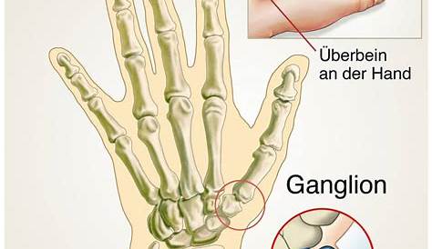 Ganglionentfernung | Orthopäde Wien - Dr. Hüthmair