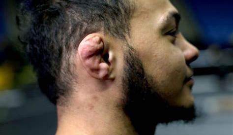 Cauliflower ear all what you need to know - Jiujitsu News