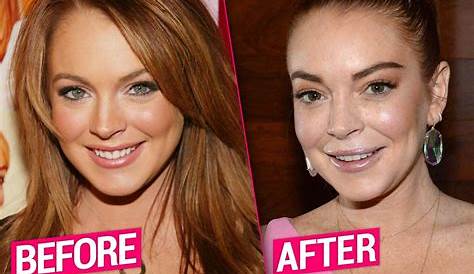Unveiling The Truth: Lindsay Lohan's Nose Job Journey Explored