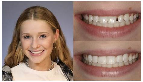 Direct Composite Veneers Before And After & Treatment 8