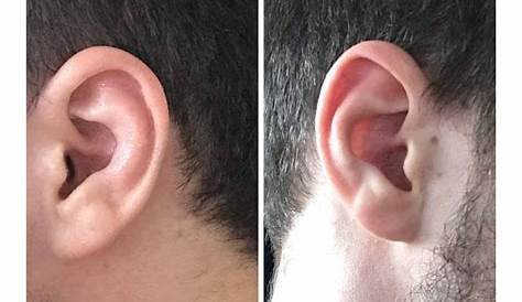 Ear Injury Treatment - Facial Trauma