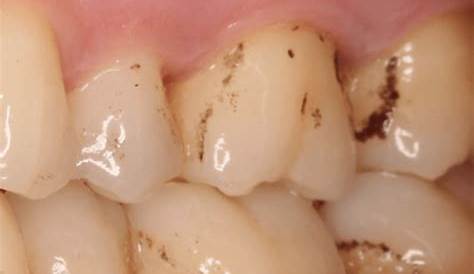 Manchas blancas en los dientes Clínica Dental Dr. Reato