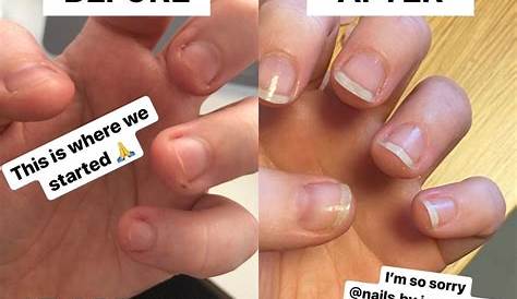 Fake Nails Cause Acne This Is What Your Fingernails Say About Your