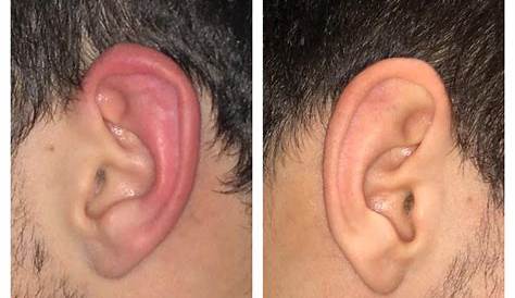 Can Cauliflower Ear Be Fixed? | Otoplasty Surgeon