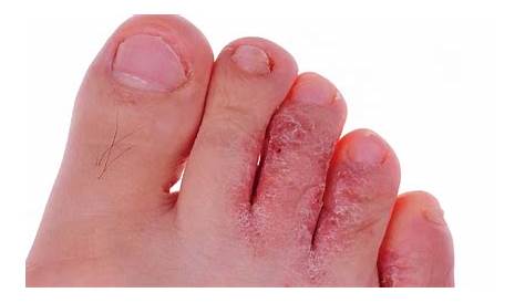 Elimina los hongos de los pies y de las manos rápidamente | Health