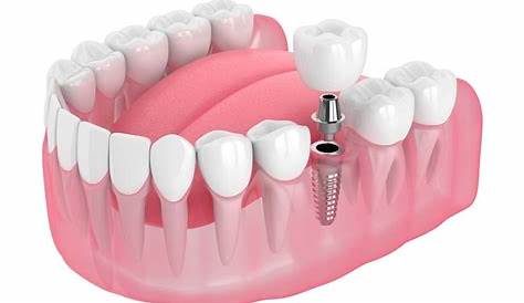 All on 6 Dental Implants in Costa Rica for Missing Teeth