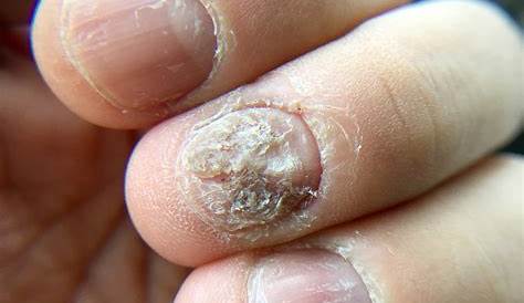 Fungus On Skin Near Nail Remedies To Get Rid Of Health Gadgetsng