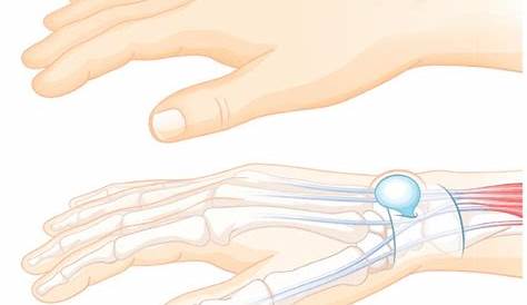 (PDF) Ganglionchirurgie des Handgelenks und der Finger