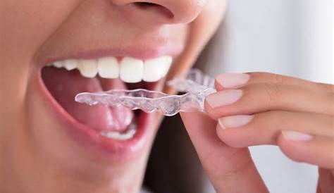 Gouttière dentaire pour redresser les dents.Invisalign