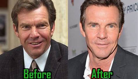 Feast On The Truth: Unraveling The Plastic Surgery Secrets Of Dennis Quaid