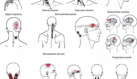 Head Aches And Trigger Point Therapy Lisa de Liema