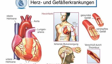 Herz-kreislauf-Erkrankungen Herzinfarkt Koronare Krankheit Symptome