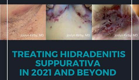 Hidradenitis Suppurativa Treatment What You Need To Know About Supprativa Book