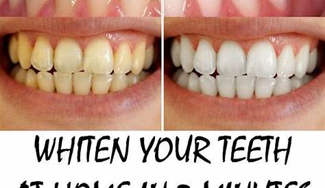 How Often Should I Whiten My Teeth At Home Ths You Whten
