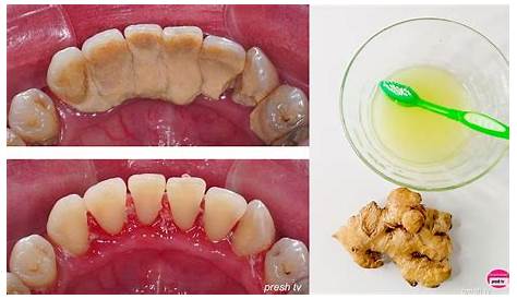 How To Clean Tartar At Home Remove And Plaque From Teeth 11
