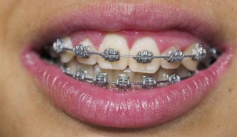 How To Get A Discount On Braces