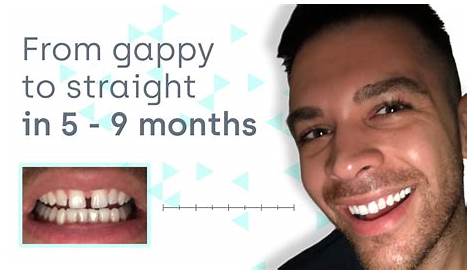 How To Hide A Gap In Your Teeth At Home Close Gp