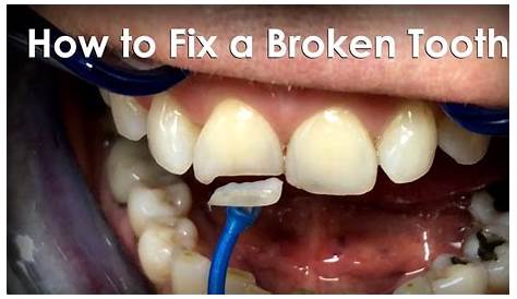 How To Remove Broken Tooth At Home Removal Of A Oth And