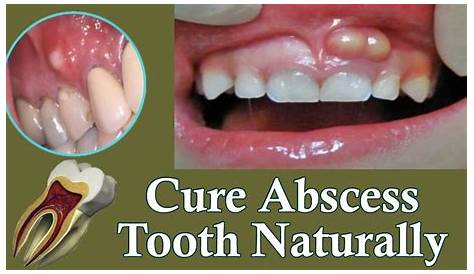 How To Treat A Dental Abscess At Home Best Ment For Oth