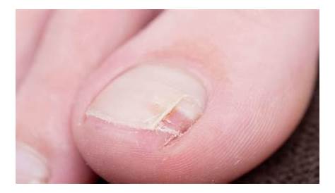 Human Toenail Broken Vertically Near Base Of Nail Transformation At Home Using