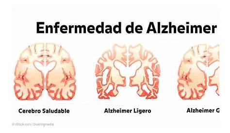 ¡Cuánta razón! / Cerebro normal VS Cerebro con Alzheimer